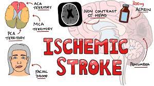 A ministroke, or transient ischemic attack (tia), occurs when part of the brain experiences a temporary lack of blood flow. Acute Ischemic Stroke Signs And Symptoms Stroke Syndromes Causes Mechanisms Treatment Youtube