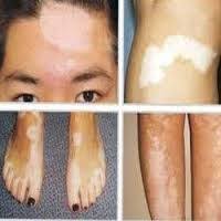 Obat Oles Vitiligo Di Apotik Formulasi 3 Kali Lebih Cepat Dalam Menghilangkan Bercak Putih Di Seluruh Tubuh Pesan Disini Bisa Kirim Barang Dulu
