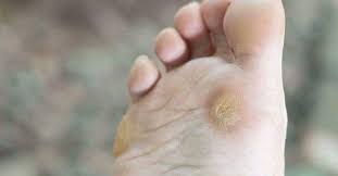 Le vinaigre blanc est un excellent remède pour soulager les cors au pied. Voici 3 Astuces Pour Lutter Contre Les Verrues Et Les Cors Aux Pieds