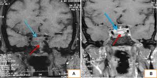 Post basic kkm 2016 : Acromegaly With Hypophosphataemia Mccune Albright Syndrome Bmj Case Reports