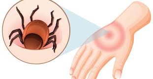 Image result for Tick Bite