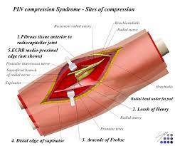 Radial Tunnel Syndrome Hand Orthobullets