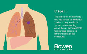 Or you may notice some common signs, including sometimes stage i lung cancer is discovered through routine tests. What Is Lung Cancer Lung Cancer Explained Bowen Icon Cancer Centre