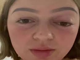 Mulher diz que olho 'pulou para fora' após força no parto; isso é possível? 