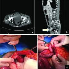 Image result for Hernia Reduction