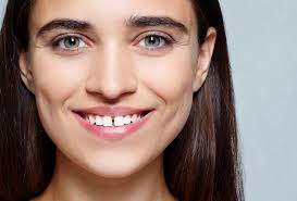There are invisalign braces, dental implants, and crowns/veneers available to correct gapped teeth in terms of aesthetics, gapped teeth are actually becoming a trend of sorts. How To Fix Gaps Between Teeth Dentistry On Lakeshore Mississauga