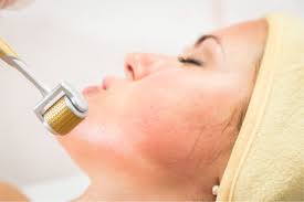 Microneedling is a dermatological procedure that can help with issues such as acne scarring, wrinkles, and microneedling is a method that some dermatologists use to treat different skin conditions. Nebenwirkungen Risiken Von Microneedling Erste Hilfe