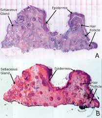 You will notice that all normal moles pictures are quite different from one another, making it harder to detect skin cancer only by a few pictures. Human Skin Under Microscope Labeled Confocal Mosaicing Microscopy Of Human Skin Ex Vivo Spectral Photo Human Microscopic Photography Human Anatomy Chart Skin