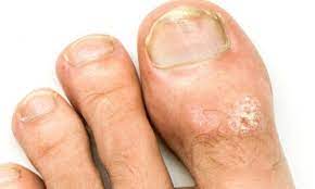 Para a psoríase ungueal que não responde ao tratamento inicial, seu médico pode sugerir um medicamento que afeta todo o corpo (terapia sistêmica). E Micose Ou Psoriase No Pe Doctor Feet
