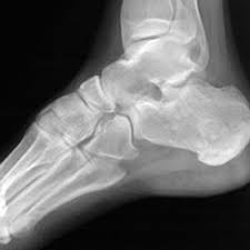 Image result for Calcaneus Compression Fracture