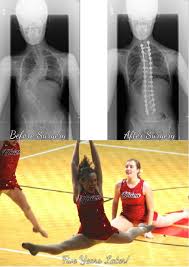 Our Journey Scoliosis Back Care After Surgery