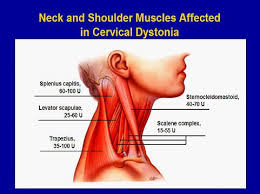 Pin On Fibromyalgia Myofascial Pain