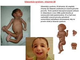 Obvykle je spojena s prodlevami. Ppt Klinefelteruv Syndrom Powerpoint Presentation Free Download Id 4732425