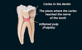 Image result for Pulpitis