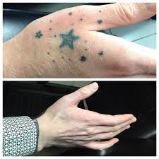 Check spelling or type a new query. Safe And Professional Tattoo Removal In Massachusetts New York City