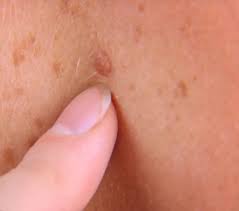 skin cancer is usually one of the most curable types of cancer. News Archives Molechex Skin Cancer And Melanoma Clinic