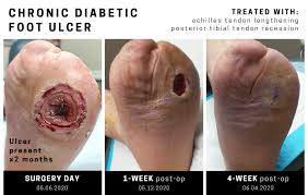 Check spelling or type a new query. Diabetic Foot Care Next Step Foot Ankle Clinic