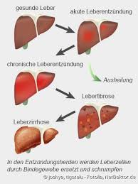 Hepatitis Leberentzundung Formen Symptome Therapie Netdoktor