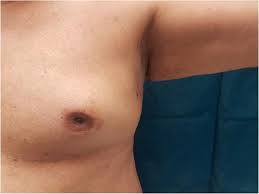 Treat her to a therapeutic massage. Bilateral Synchronous Breast Cancer In Elderly Male Springerlink
