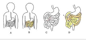 Image result for Intestinal Malrotation