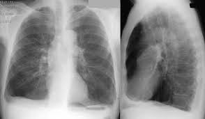 Radiologie Der Lunge Lehrsammlung Copd