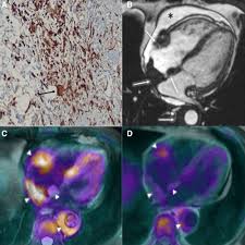 Todos os dias milhares arriscam a vida pela ausência de passeios e passadeiras em toda a extensão da estrada da. Cardiac Involvement In Erdheim Chester Disease Circulation Cardiovascular Imaging