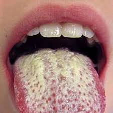 Image result for Puchýře na jazyku