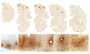 Cte has been known to affect boxers since the 1920's (when it was initially termed punch drunk cte is not limited to current professional athletes; Learn The Symptoms In The Four Stages Of Cte The Boston Globe