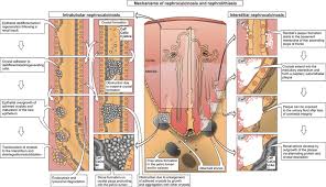 Image result for Calcium Nephrolithiasis