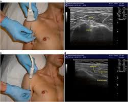 Image result for Biceps Tendon Injection