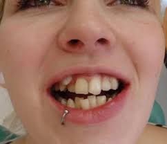 This patient achieved this result after 8 months classic orthodontic  treatment with elastics. How is this possible and does it look stable ?