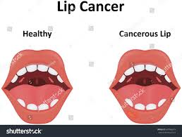 Image result for Lip Cancer
