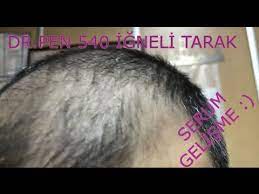 Dermaroller 540 Igneli Titanyum Sac Cikarma Taragi Saclosyonu Sactarak Sacserumu Maviserum Youtube