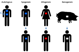 Image result for Transplantation