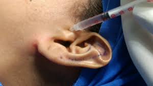 Image result for Ear Nerve Block