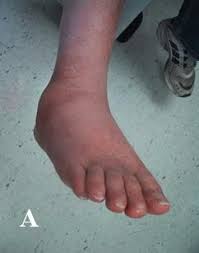 The Charcot Foot Treatment To Minimize Progression Of Deformity
