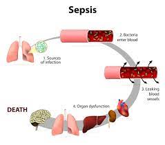 Like strokes or heart attacks, sepsis is a medical emergency that requires rapid diagnosis and treatment. What Are The 3 Stages Of Sepsis Sepsis Severe I Shock