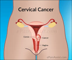 In this case, these cells develop in the cervix. Must Read 9 Warning Signs Of Cervical Cancer Teelamford No 1 Home Of All Needs