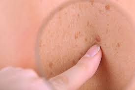 Another early sign of scc is a scaly area that may look like a rash and can develop into an open sore. Skin Cancer Types Preventive Measures 1st For Credible News
