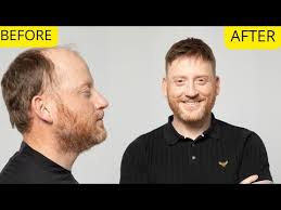 Hair Transformation Non Surgical Hair Replacement System