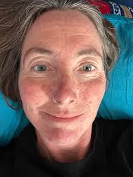 A year ago I posted talking about my cancer. I've still got cancer. But I  now have a Cetuximab (immunotherapy drug) face rash (zoom in)to show off as  well. Does the rash