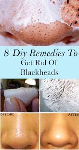8 Diy Remedies To Get Rid Of Blackheads In 2020 Get Rid Of Blackheads Skin Care Treatments Natural Skin Care Diy