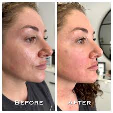 Check out this beauty and her instant glow ✨ This is 1 of 2 treatment of  Cellenis Derma PRP, we focused