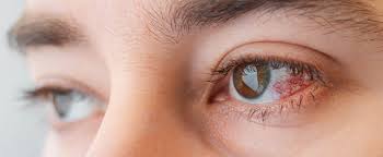 Image result for Keratitis
