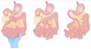 Image result for Intestinal Malrotation