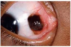 Image result for nevus sclerae