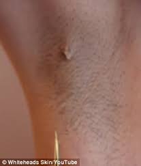 It produces a raised, red bump that looks like a little pimple. Ingrown Hair Extraction Is Eclipsing Pimple Popping Porn Express Digest