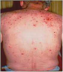 Image result for Neurotic Excoriation