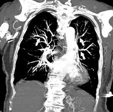 Thrombosis is the formation of a blood clot inside a blood vessel, obstructing the flow of blood through the circulatory system. Embolia Pulmonar Trastornos Pulmonares Manual Msd Version Para Profesionales