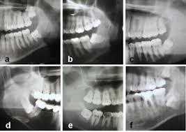 Wann müssen die weisheitszähne raus? Weisheitszahne Ziehen Lassen Schmerz Oder Net Arzt Zahne Kiefer